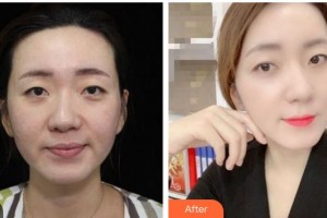 成都黃氏百佳整形醫(yī)院杜磊整形價格表附“熱瑪吉”多方面部提升案例展示