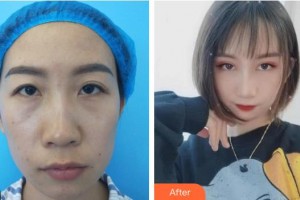 成都錦城整形美容醫(yī)院丁獻松整形價格表附雙眼皮案例展示