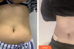 成都藝星醫(yī)療美容醫(yī)院閻偉整形價格表附腰腹吸脂案例展示