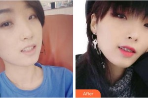 成都華顏醫(yī)療美容門診部曾小娟整形價格表附牙齒隱形矯正案例展示