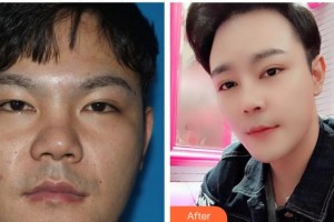 成都艾尚醫(yī)學美容門診部劉銘整形價格表附鼻部手術(shù)整形案例展示