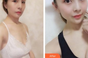 成都雙楠醫(yī)院整形美容科李映雨整形價格表附豐胸案例展示