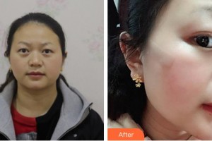成都華康醫(yī)院美容整形外科劉可新整形價格表附面部疤痕修復(fù)案例展示