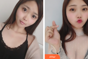 廣州美涵醫(yī)療整形美容醫(yī)院張成春整形價(jià)格表附自體脂肪隆胸案例展示