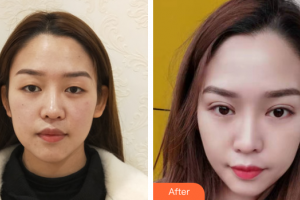 廣州海峽醫(yī)學(xué)整形美容醫(yī)院閆愛躍整形價(jià)格表附格蘭氏線雙眼皮案例展示