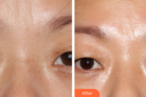 廣州美涵醫(yī)療整形美容醫(yī)院李晶整形價(jià)格表附皮膚管理案例展示