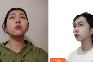 廣州美恩整形美容醫(yī)院楊紅云整形價(jià)格表附光子嫩膚案例展示