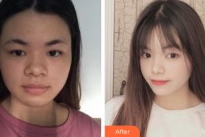 廣州美恩整形美容醫(yī)院羅凌整形價(jià)格表附面部埋線提升案例展示