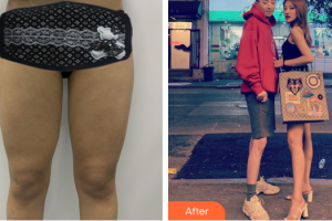 廣州新時(shí)代整形美容醫(yī)院張光疇整形價(jià)格表附大腿吸脂案例展示