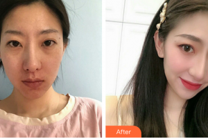 廣州曙光醫(yī)學(xué)美容醫(yī)院杜錫萍整形價格表附光子嫩膚案例展示