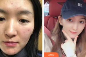 廣州新時代整形美容醫(yī)院紀(jì)麗萍整形價格表附微針祛痘 案例展示