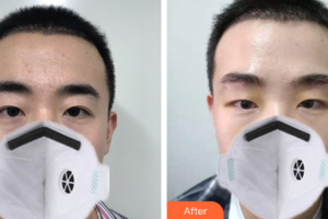 廣州曙光醫(yī)學(xué)美容醫(yī)院蔣晟整形價格表附假體墊眉弓案例展示