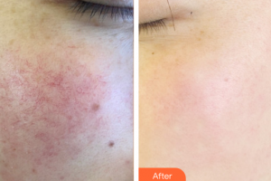 廣州曙光醫(yī)學(xué)美容醫(yī)院董沖整形價格表附美白嫩膚案例展示