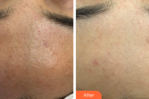 廣州曙光醫(yī)學(xué)美容醫(yī)院杜小燕整形價格表附海菲秀醫(yī)學(xué)深層清潔案例展示