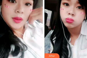 廣州曙光醫(yī)學(xué)美容醫(yī)院熊飛整形價格表附冷光美白案例展示