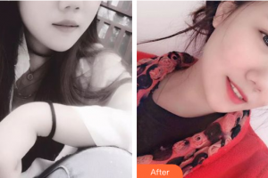 廣州曙光醫(yī)學(xué)美容醫(yī)院張昌輝整形價格表附瓷貼面案例展示