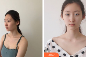 廣州曙光醫(yī)學(xué)美容醫(yī)院項蕾紅整形價格表附光子嫩膚案例展示