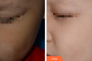 廣州曙光醫(yī)學(xué)美容醫(yī)院吳艷整形價格表附祛斑祛痣案例展示