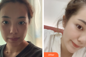 廣州曙光醫(yī)學(xué)美容醫(yī)院馬小兵整形價格表附光子嫩膚案例展示