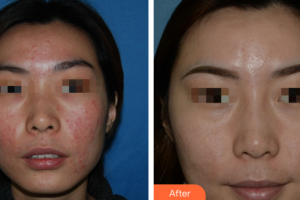 廣州曙光醫(yī)學(xué)美容醫(yī)院陳向東整形價格表附清潔祛痘案例展示