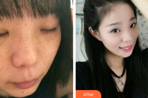 廣州曙光醫(yī)學(xué)美容醫(yī)院梁虹整形價格表附雙機(jī)祛斑案例展示