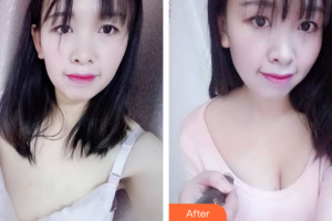 廣州曙光醫(yī)學(xué)美容醫(yī)院郭澍整形價格表附自體脂肪隆胸案例展示