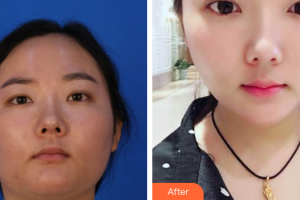 廣州曙光醫(yī)學(xué)美容醫(yī)院楊慧蘭整形價格表附皮膚管理案例展示