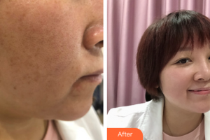 廣州曙光醫(yī)學(xué)美容醫(yī)院李利整形價格表附微針美塑案例展示