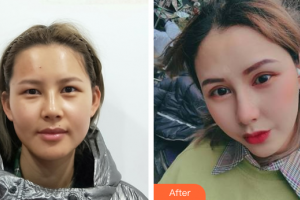 廣州韓妃醫(yī)學(xué)美容醫(yī)院李光琴整形價格表附格萊美眼部手術(shù)案例展示