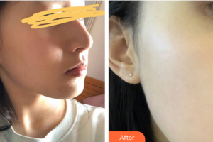 廣州華美醫(yī)療美容醫(yī)院易陽亮整形價格表附光子嫩膚案例展示