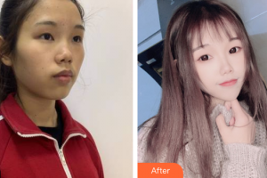 廣州曙光醫(yī)學(xué)美容醫(yī)院黃詠梅整形價格表附光子嫩膚案例展示