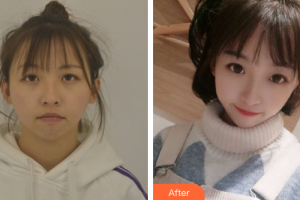 廣州華美醫(yī)療美容醫(yī)院黃承國整形價格表附下巴整形案例展示