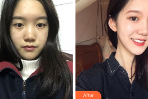 廣州華美醫(yī)療美容醫(yī)院金漢勛整形價格表附雙眼皮案例展示