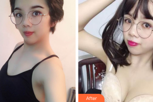 廣州華美醫(yī)療美容醫(yī)院洪永泰整形價格表附自體脂肪隆胸案例展示