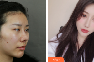 廣州華美醫(yī)療美容醫(yī)院鄭智勛整形價格表附顴骨+夾脂墊案例展示