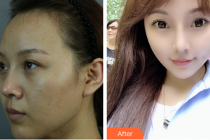 廣州時光整形美容醫(yī)院宋彥整形價格表附顴骨+頰脂墊+中面部提升術案例展示