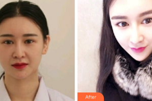 廣州時光整形美容醫(yī)院金相虎整形價格表附納米V-FACE分層吸脂術案例展示