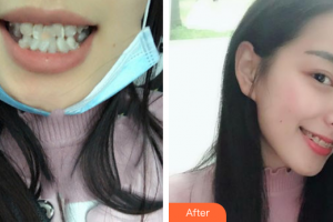 廣州韓妃醫(yī)學美容醫(yī)院徐建整形價格表附半隱形牙齒矯正案例展示