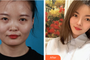 廣州市荔灣區(qū)人民醫(yī)院整形美容中心山口青木整形價格表附臉型（顴骨+下頜角）+鼻部手術案例展示