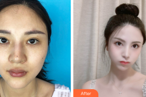 廣州韓妃醫(yī)學美容醫(yī)院金明轍整形價格表附眼瞼下至+面部吸脂+M唇案例展示