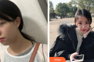 廣州海峽醫(yī)學整形美容醫(yī)院吳光興整形價格表附超激光美膚激光案例展示