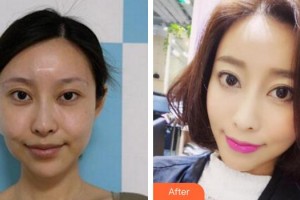 成都素美醫(yī)療美容診所余平清整形價(jià)格表附埋線提升案例展示