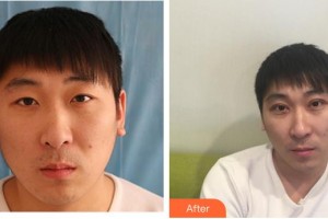 成都華康醫(yī)院美容整形外科錢凱整形價(jià)格表附切開(kāi)雙眼皮案例展示