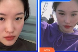 成都恩喜醫(yī)學(xué)整形美容醫(yī)院李光虎整形價(jià)格表附5S重瞼術(shù)+超微創(chuàng)開(kāi)內(nèi)眥案例展示