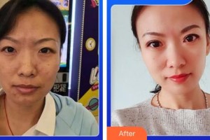 成都素美醫(yī)療美容診所楊華博整形價(jià)格表附5s重瞼術(shù)+超微創(chuàng)開(kāi)內(nèi)眥案例展示