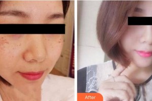 成都素美醫(yī)療美容診所陳丹整形價(jià)格表附激光去黃褐斑案例展示