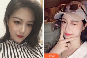 成都藝星醫(yī)療美容醫(yī)院謝雯整形價(jià)格表附嫩膚祛斑案例展示