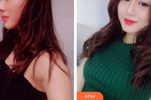 成都百齡駐顏醫(yī)學(xué)美容門診部康耀整形價(jià)格表附隆胸案例展示