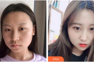 成都泊菲凱莉醫(yī)學(xué)整形美容醫(yī)院許文澍整形價(jià)格表附埋線提升案例展示