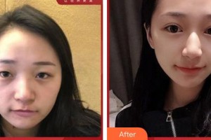 成都美極醫(yī)療美容門診部劉大琨整形價(jià)格表附切開(kāi)雙眼皮案例展示